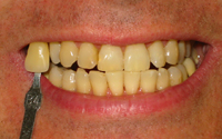 during-tooth-removal