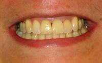 yellow-teeth