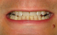 after-teeth
