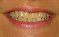 teeth-after-treatment