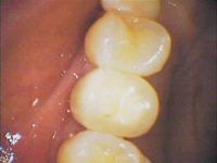 dental-implants-after