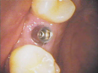 dental-implants-before