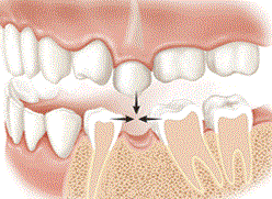 dental-implants-wimbledon