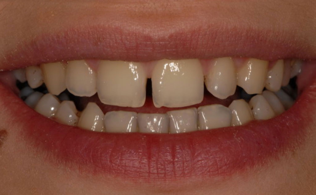 teeth-before